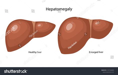 Enlarged Liver