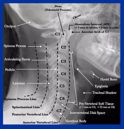 Msk Xray Practice Flashcards Quizlet