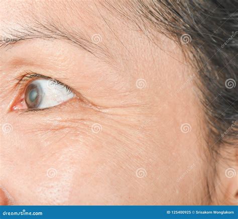 Wrinkles Around The Eyes And Skin Problems Stock Image Image Of