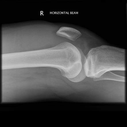 Fat pad separation sign (knee joint effusion) | Radiology Reference Article | Radiopaedia.org