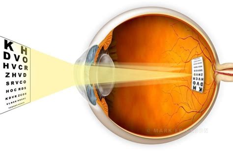 Astigmatism schematic artwork depicting refractive error