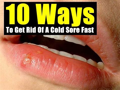 10 Ways To Get Rid Of A Cold Sore Fast Cold Sores Remedies Cold Sore