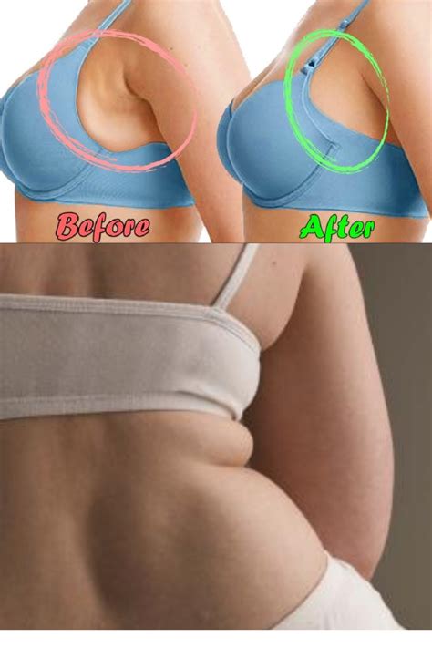 How To Get Rid Of Side Boob Fat Dr Answered Artofit