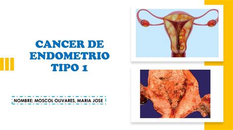 Cáncer endometrial tipo 1 med student uDocz