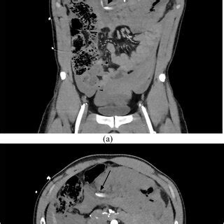 CT Angiogram of the abdomen and pelvis with evidence of hemoperitoneum ...