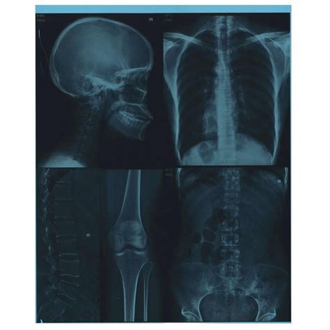 Printer Using Laser Medical Blue X Ray Film 35X43 Cm Inkjet X Ray