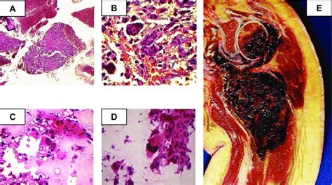 Representative Histologic Images Of Specimens Of Telangiectatic