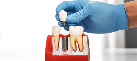 Dental Implants Vs Dentures Weighting The Pros And Cons