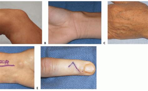 Open And Arthroscopic Excision Of Ganglion Cysts And Related Tumors Otosection