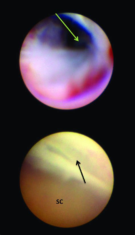 A B The Simultaneous Sialendoscopy Provides A View To The End Of The