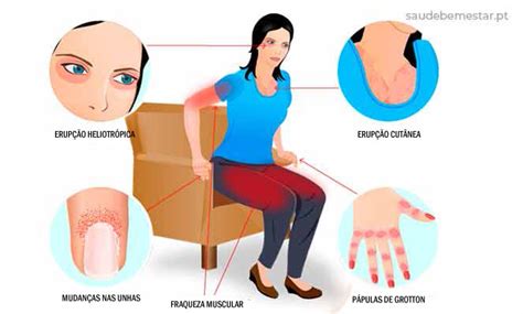 Dermatomiosite O Que É
