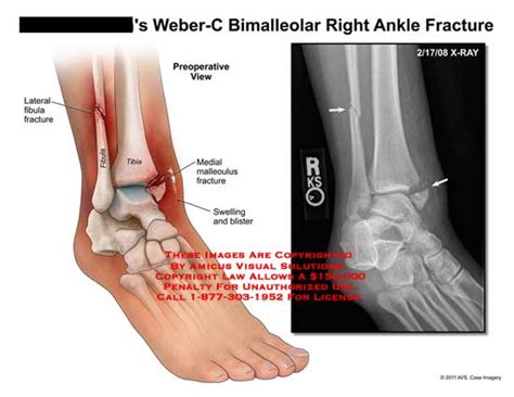 Amicus Illustration Of Amicusinjuryanklefractureweber C