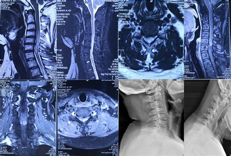 Decoding Unusual Mr Findings Spinal Cord Edema In Atypical Cervical