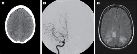 Clinical Worsening In Reversible Cerebral Vasoconstriction Syndrome Neurology Jama Neurology