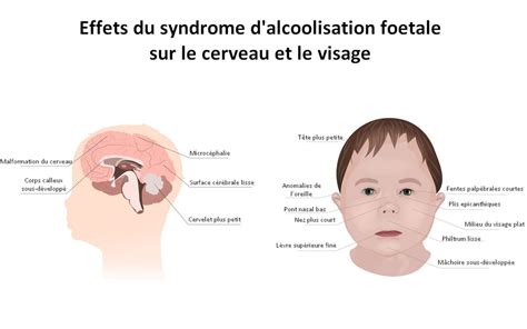 Syndrome D Alcoolisation F Tale Signes Typiques Visage