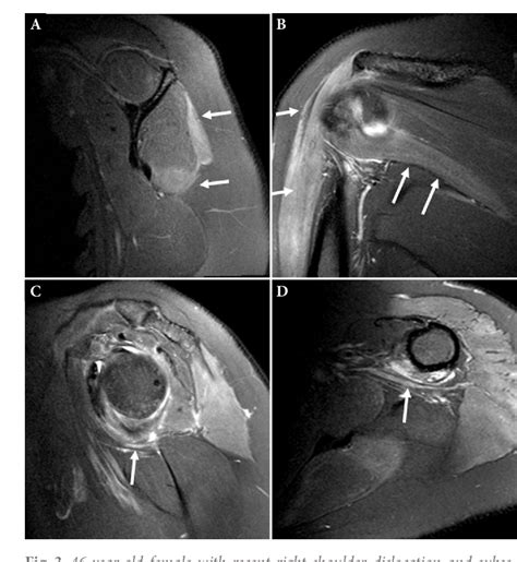 Figure From Role Of High Resolution Ultrasound And Magnetic Resonance