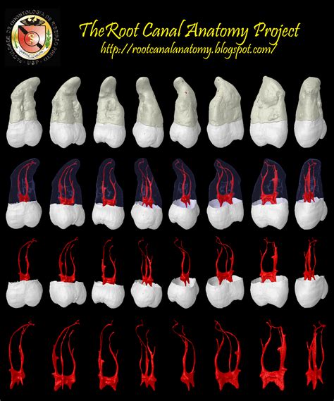 The Root Canal Anatomy Project Maxillary Third Molar