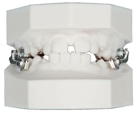 Cantilever Herbst Appliance Protec Dental