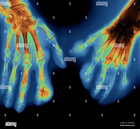 Coloured X-ray of the hands of a 65 year old patient with gout in the ...