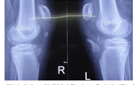 Table 1 From Simultaneous Bilateral Tibial Tuberosity Avulsion