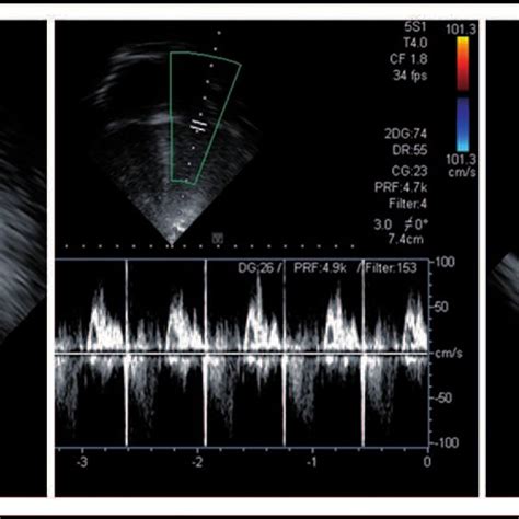 Doppler Echocardiogram Showing Normal Biventricular Cardiac Function