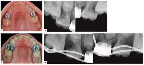 Dentistry Journal | Free Full-Text | Ectopic Permanent Molars: A Review