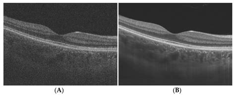 Analysis Of Optical Coherence Tomography Images Encyclopedia Mdpi