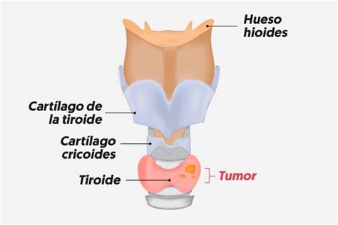 Tiroidectomía cómo se realiza principales tipos y complicaciones