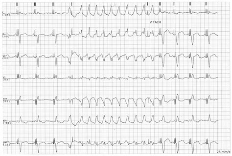 Ekg Rhythm Strip