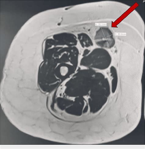 Figure 5 From Unusual Multiple Recurrences Of Soft Tissue Giant Cell