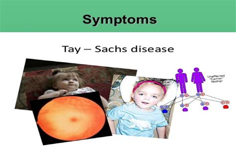 What Is Tay Sachs Disease Symptoms Causes And More