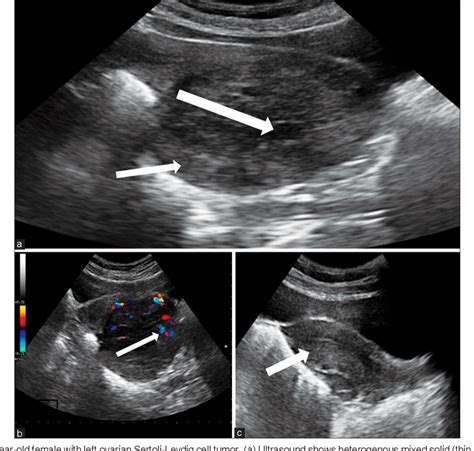 Figure 1 From Sertoli Leydig Cell Tumor Of Ovary In A Young Female A