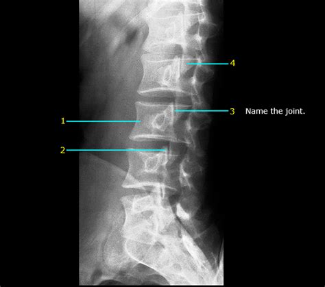 Abdomen Lumbar Spine Oblique View 5 Diagram Quizlet