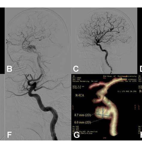 Figure Right Carotid Cavernous Fistula Ccf An Adult Patient Download Scientific Diagram