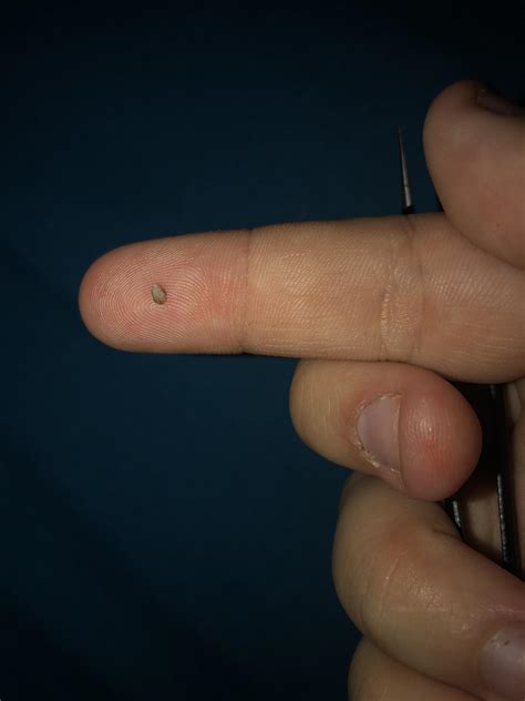 Got This Sucker On My Bikini Line R Popping