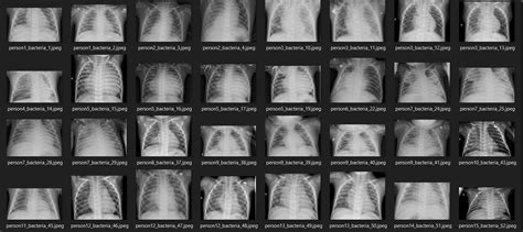 How Does Pneumonia Detection Using Cnn Work In Python