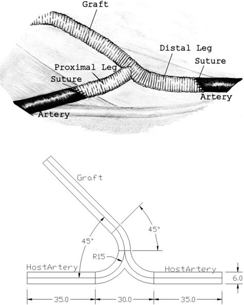 Computational Investigations Of A New Prosthetic Femoral Popliteal Bypass Graft Design Journal