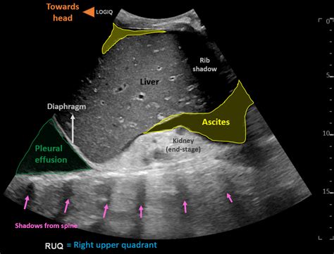 Ascites Vs Pleural Effusion Ultrasound 9424 | The Best Porn Website