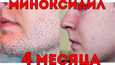 Миноксидил для бороды. ДО и ПОСЛЕ - ЩЕТИНА за 4 месяца! Максач бородач ...