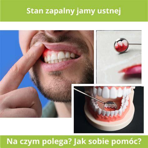 Stan Zapalny Jamy Ustnej Teslomag