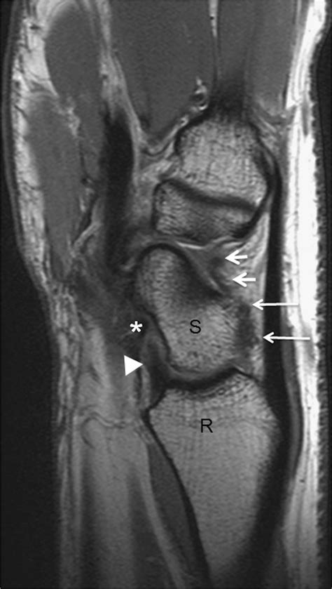 Normal Proton Density Pd Weighted Sagittal Mri Of The Wrist At The