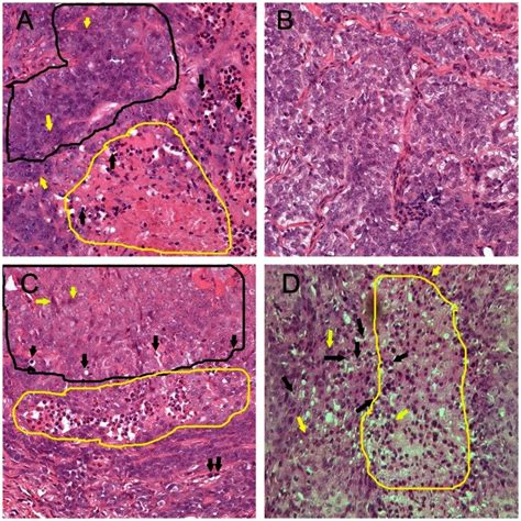 Features Identified Histopathologically Are Shown As Follows Areas Of