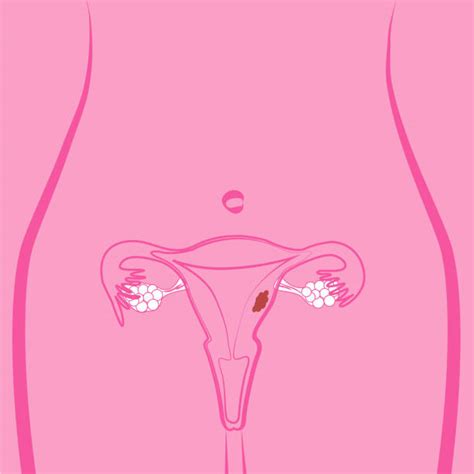 350 Uterine Fibroid Stock Illustrations Royalty Free Vector Graphics