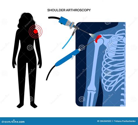 Shoulder Arthroscopy Poster Stock Vector Illustration Of Treatment