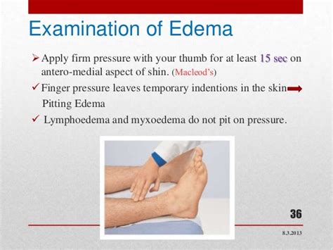 Edema