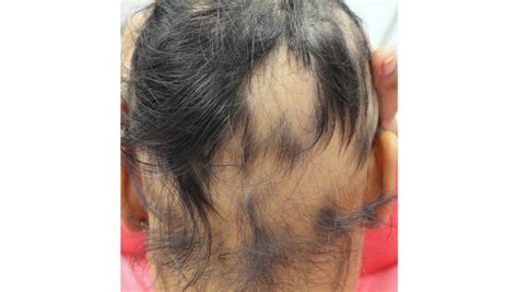 How To Prevent Hair Loss Team Dermatology