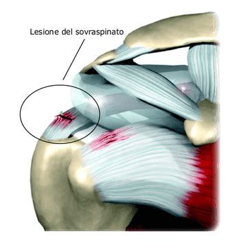 La Cuffia Dei Rotatori Cosa Come Curarla Una Guida Completa