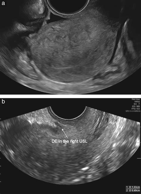 Transvaginal Ultrasound For Diagnosis Of Deep Endometriosis Involving