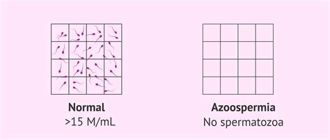 Normal Sperm Sample And Semen Sample With Azoospermia