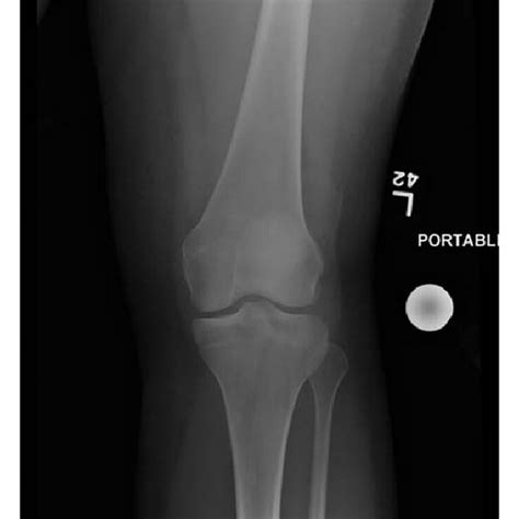 Initial Ct Scans Of Left Tibia Showing Fracture Of Lateral Tibial Condyle Download Scientific